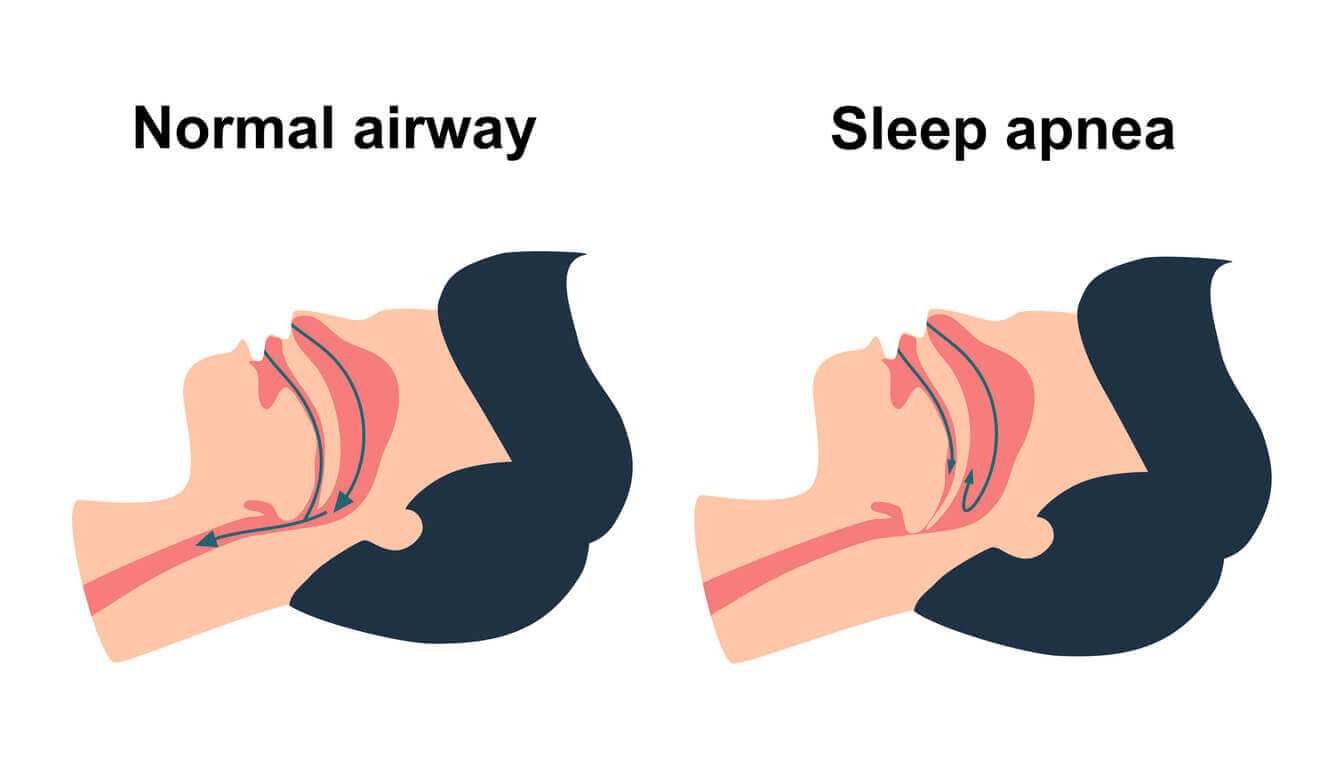 Sleep Apnea: What You Need to Know About This Silent Night Time
